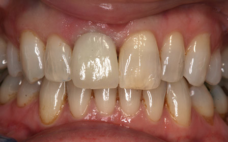 After treatment