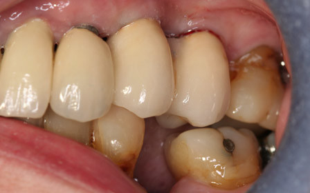 After treatment