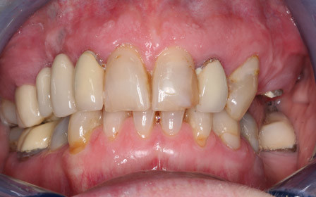 Before treatment