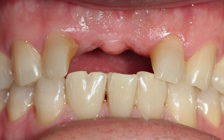 Before treatment