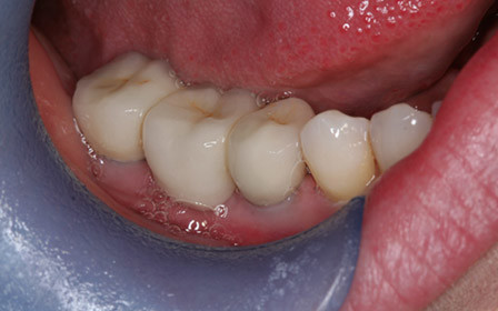 After treatment