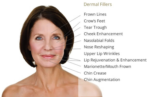 Dermal Fillers