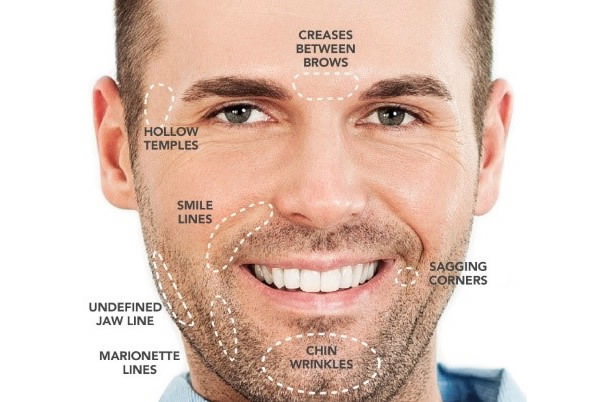 Dermal Fillers