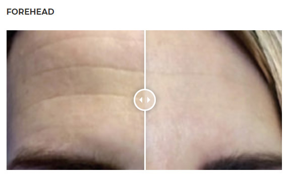 Forehead