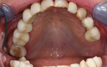 Implants After